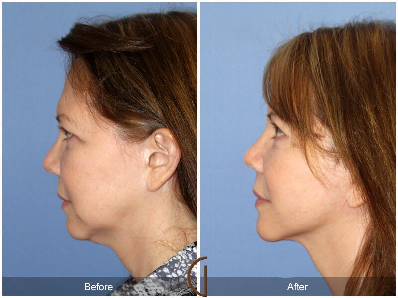 Facelift Ethnic Before & After Photo