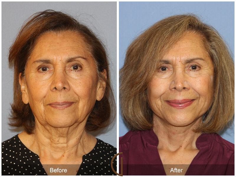 Facelift Ethnic Before & After Photo