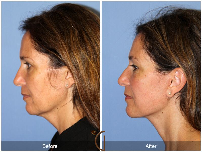 Facelift Ethnic Before & After Photo