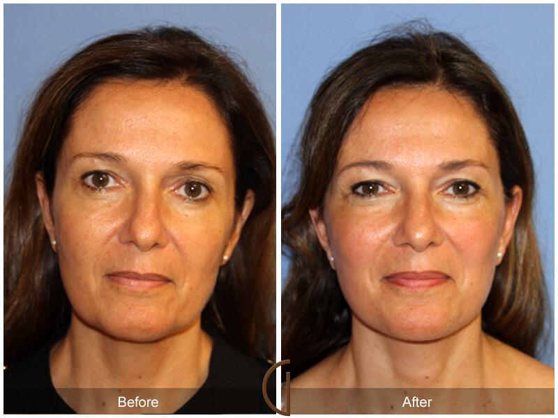 Facelift Ethnic Before & After Photo