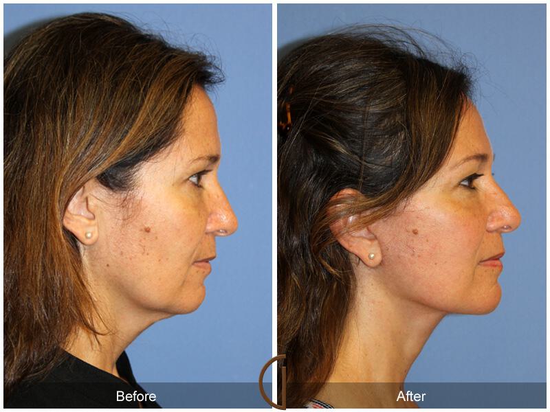 Facelift Ethnic Before & After Photo