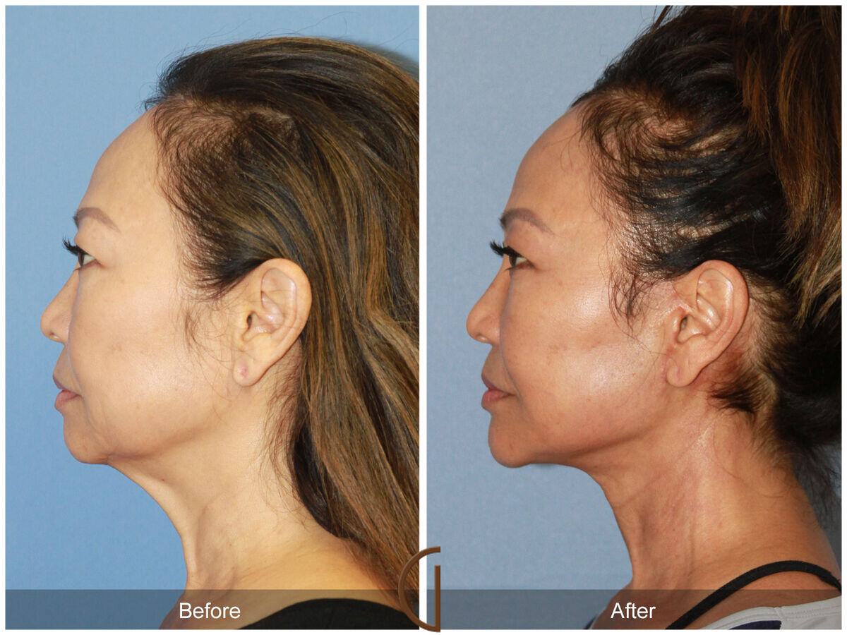 Facelift Ethnic Before & After Photo