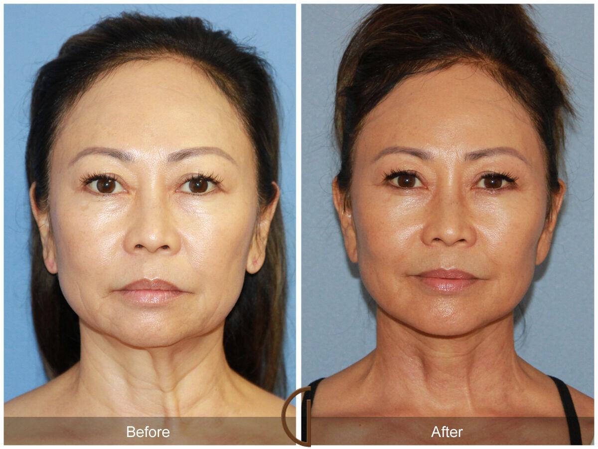 Facelift Ethnic Before & After Photo