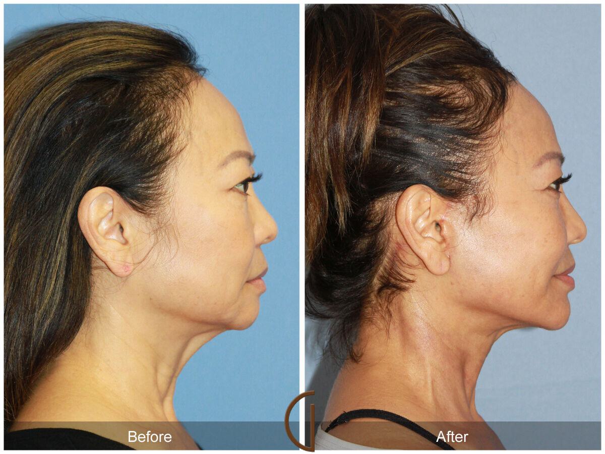 Facelift Ethnic Before & After Photo