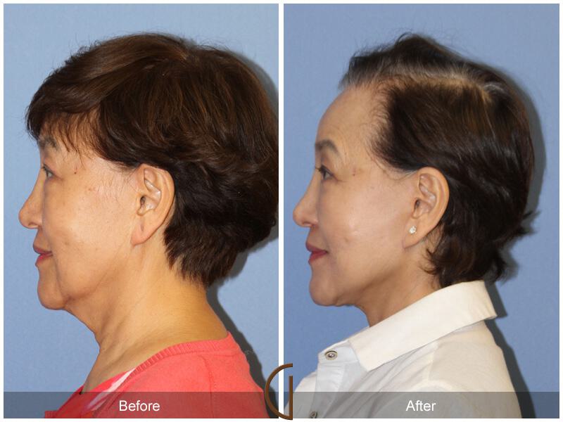 Facelift Ethnic Before & After Photo