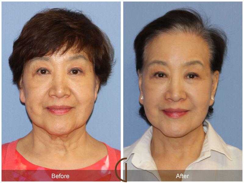 Facelift Ethnic Before & After Photo