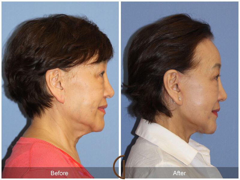 Facelift Ethnic Before & After Photo