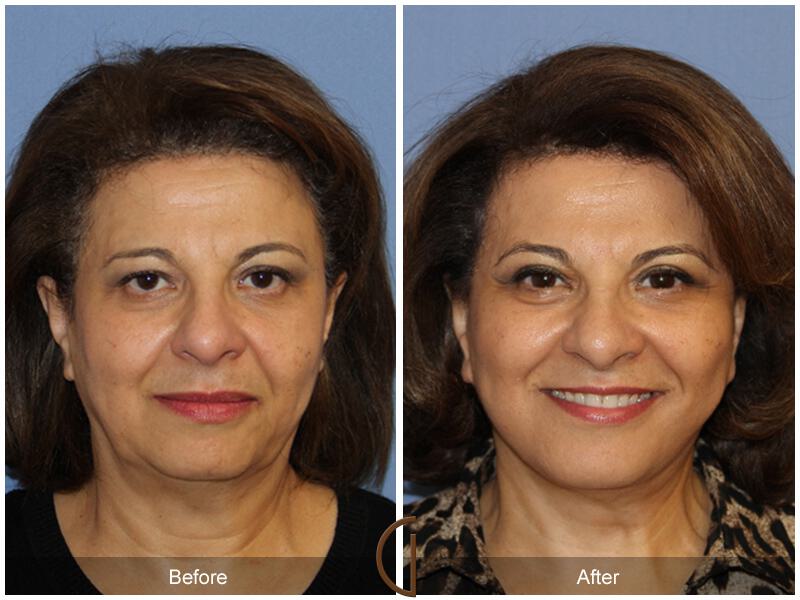 Facelift Ethnic Before & After Photo