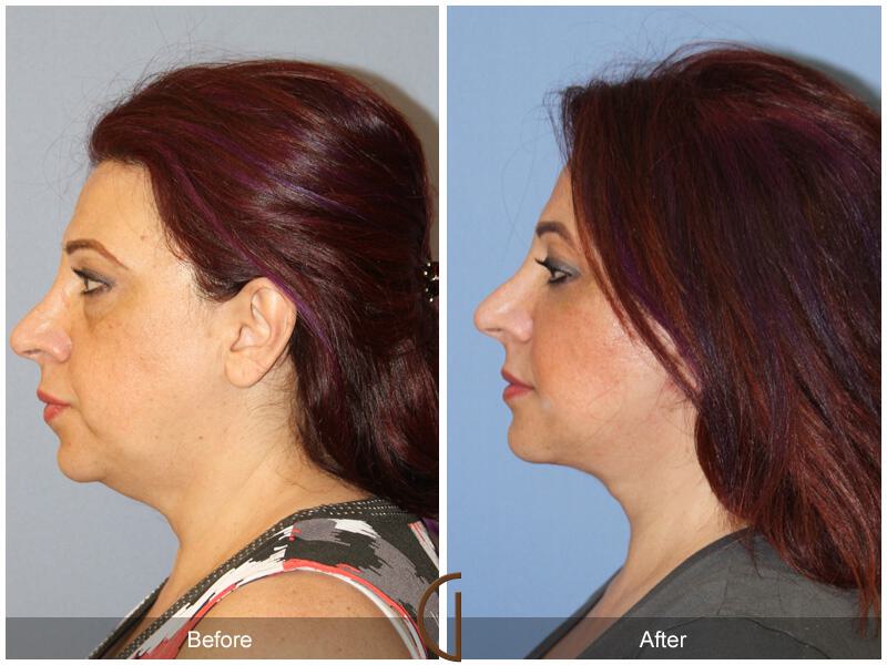 Facelift Ethnic Before & After Photo