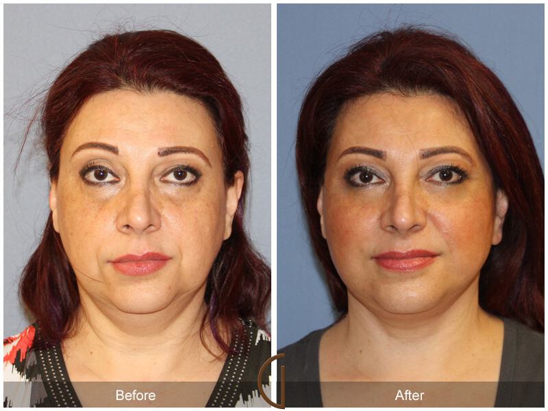 Facelift Ethnic Before & After Photo