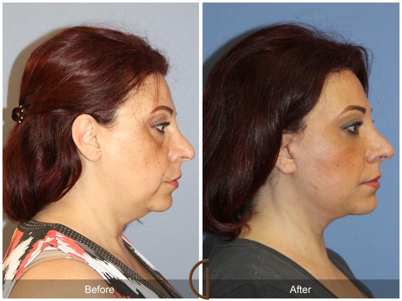 Facelift Ethnic Before & After Photo