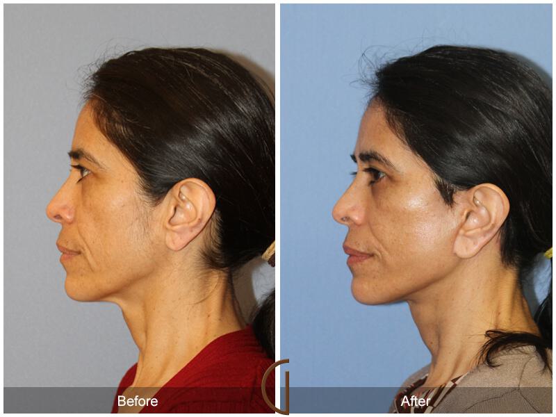 Facelift Ethnic Before & After Photo