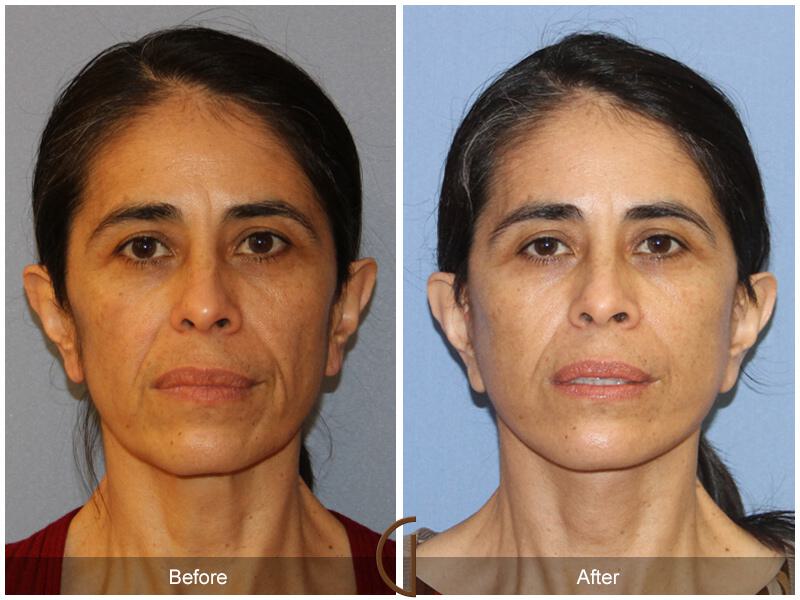 Facelift Ethnic Before & After Photo