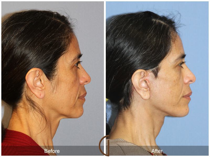 Facelift Ethnic Before & After Photo