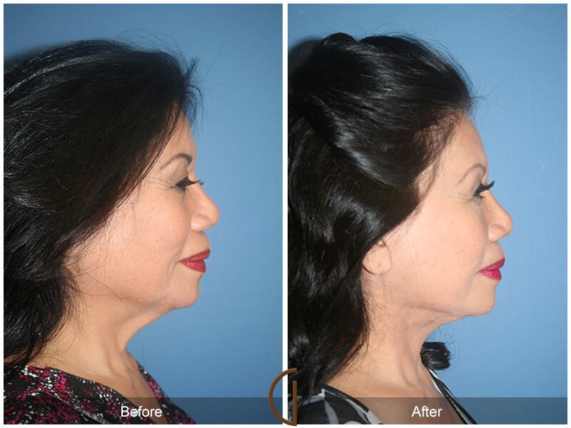 Facelift Ethnic Before & After Photo