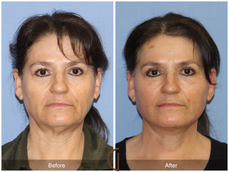 Facelift Ethnic Before & After Photo