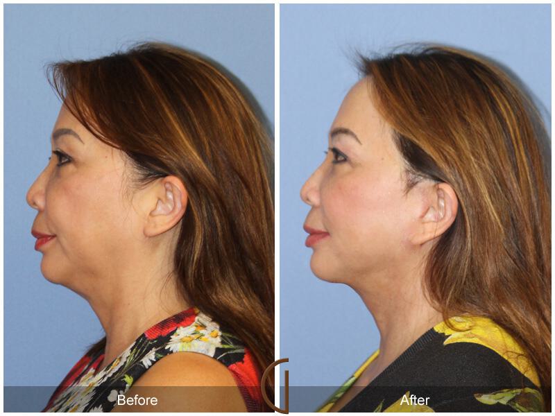 Facelift Ethnic Before & After Photo