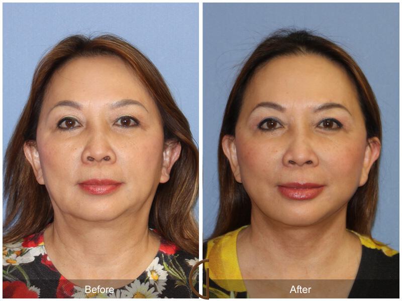 Facelift Ethnic Before & After Photo