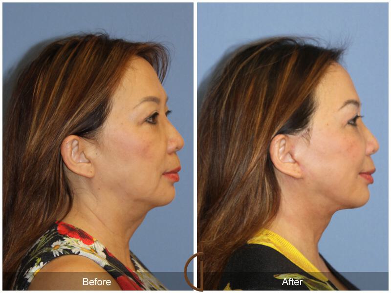 Facelift Ethnic Before & After Photo