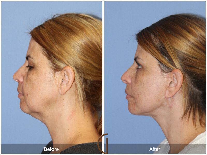 Facelift Ethnic Before & After Photo