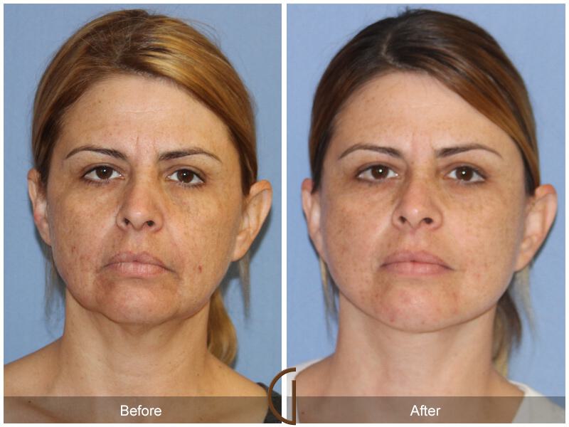 Facelift Ethnic Before & After Photo