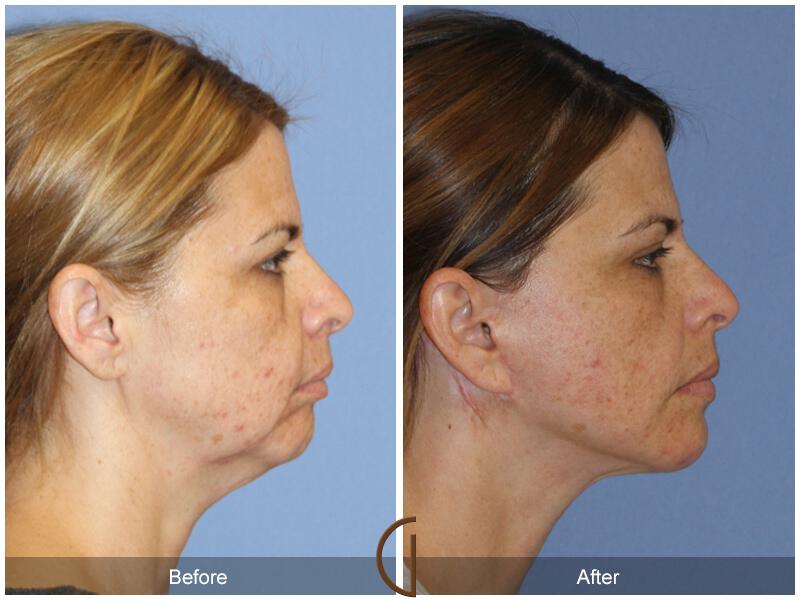 Facelift Ethnic Before & After Photo