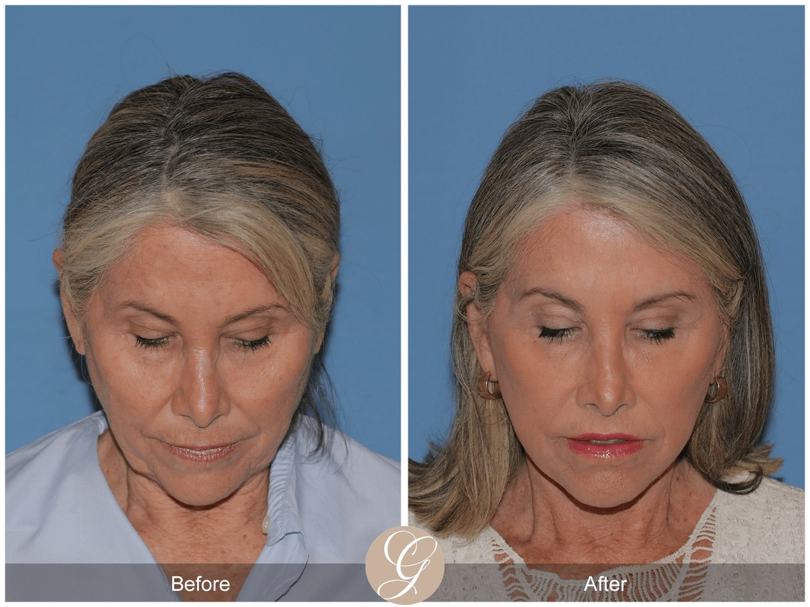 Facelift  Before & After Photo