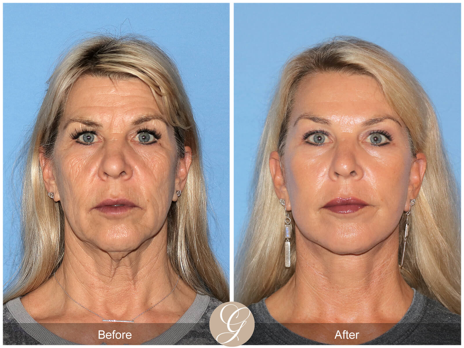 Facelift  Before & After Photo