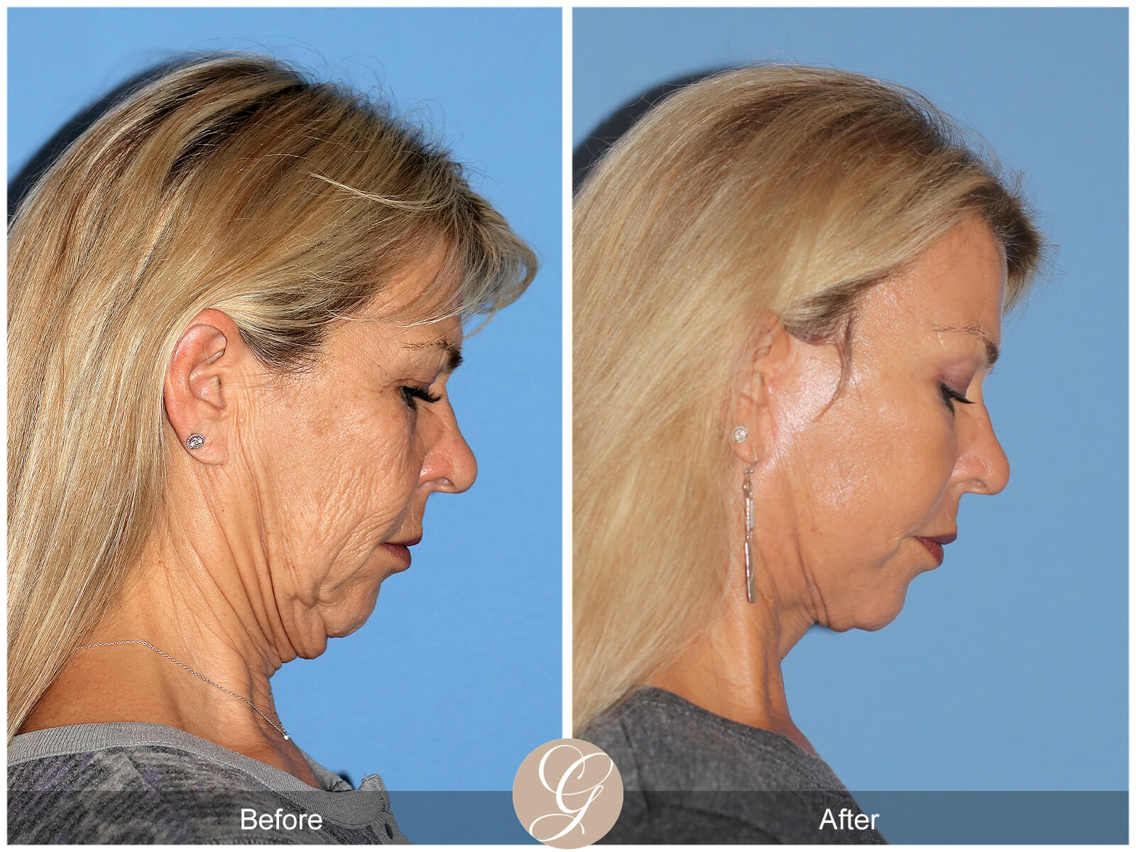 Facelift  Before & After Photo