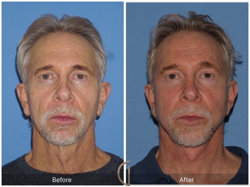 Facelift Male Before & After Photo