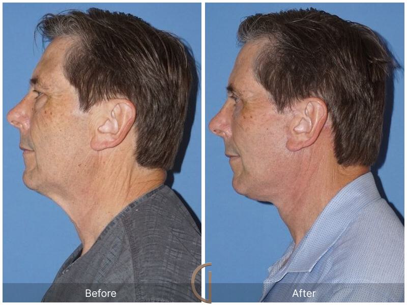 Facelift Male Before & After Photo