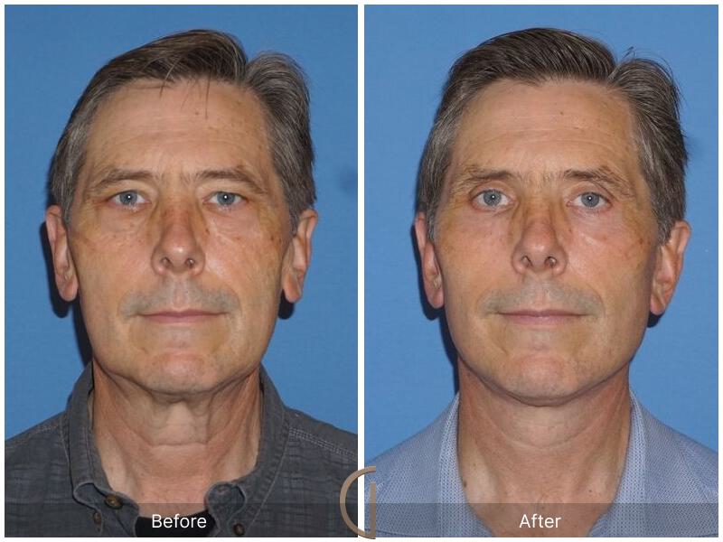 Facelift Male Before & After Photo