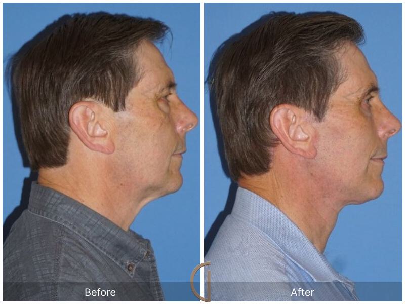 Facelift Male Before & After Photo