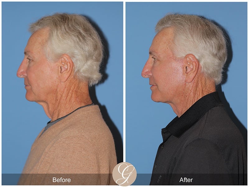 Facelift Male Before & After Photo