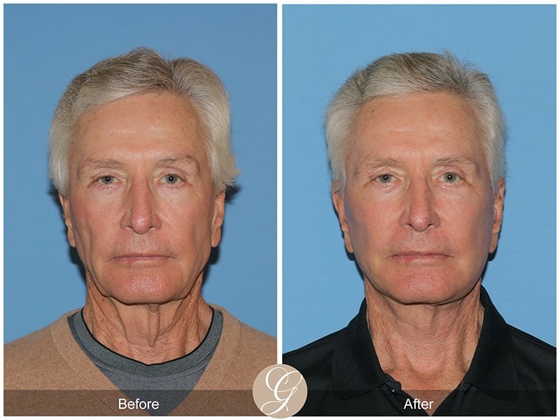 Facelift Male Before & After Photo