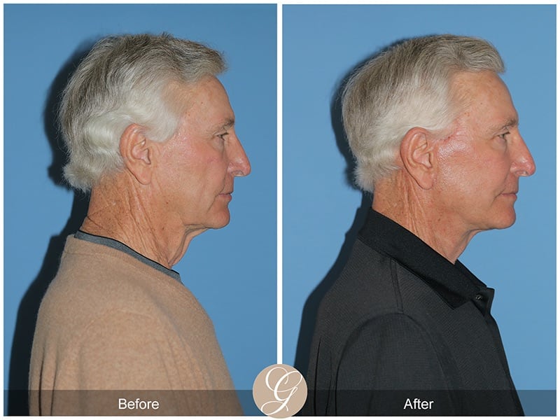 Facelift Male Before & After Photo