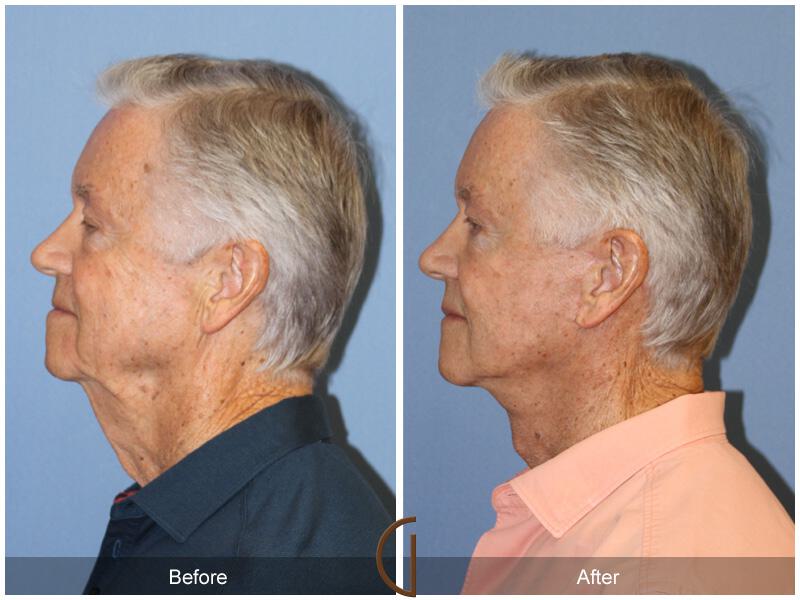 Facelift Male Before & After Photo