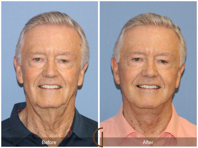 Facelift Male Before & After Photo