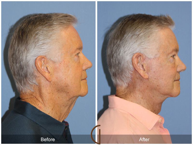 Facelift Male Before & After Photo