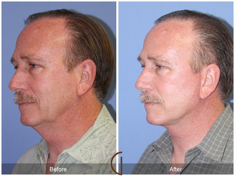 Facelift Male Before & After Photo