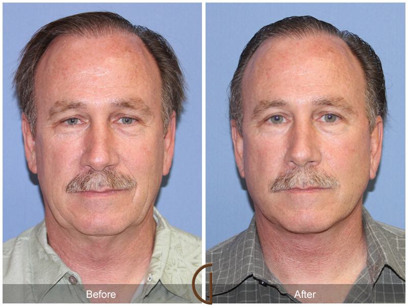 Facelift Male Before & After Photo