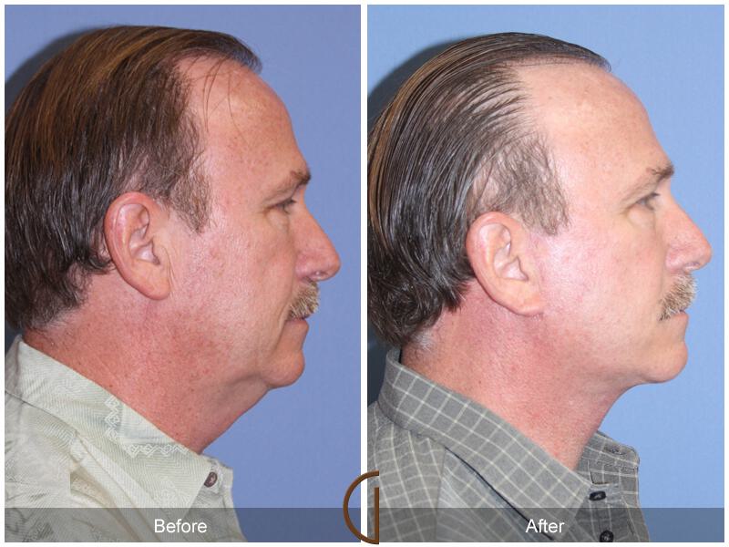 Facelift Male Before & After Photo