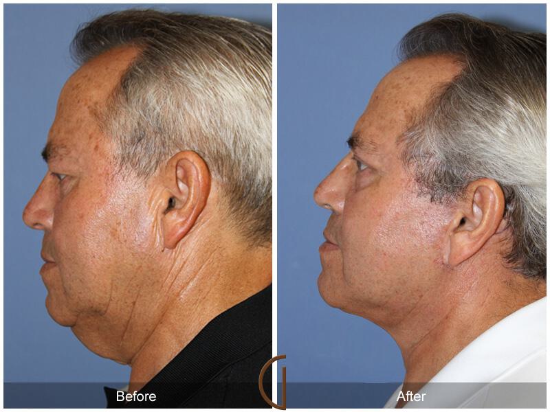 Facelift Male Before & After Photo