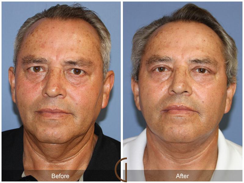 Facelift Male Before & After Photo