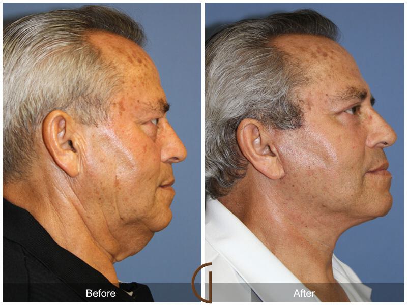 Facelift Male Before & After Photo