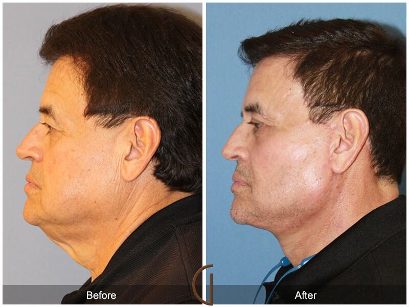 Facelift Male Before & After Photo