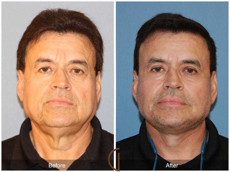 Facelift Male Before & After Photo