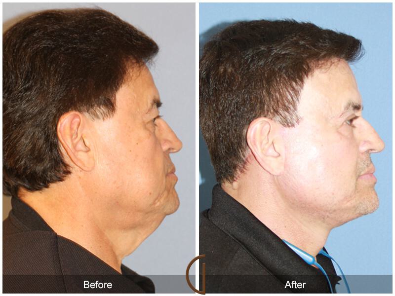 Facelift Male Before & After Photo