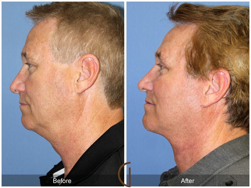 Side Profile of Man Before and After Facelift Orange County