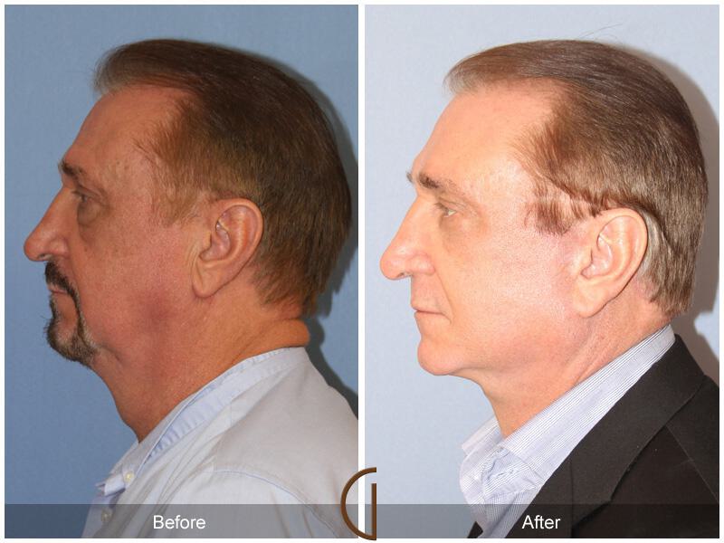 Facelift Male Before & After Photo